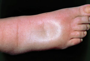 edema booties