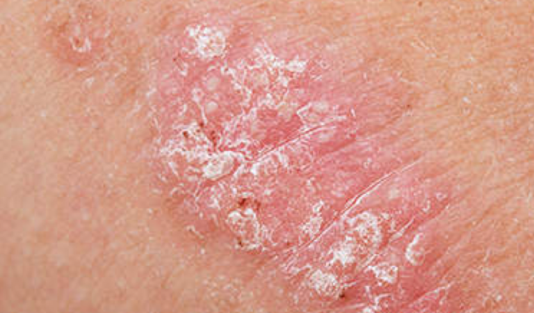 Psoriasis Dermatology Conditions And Treatments