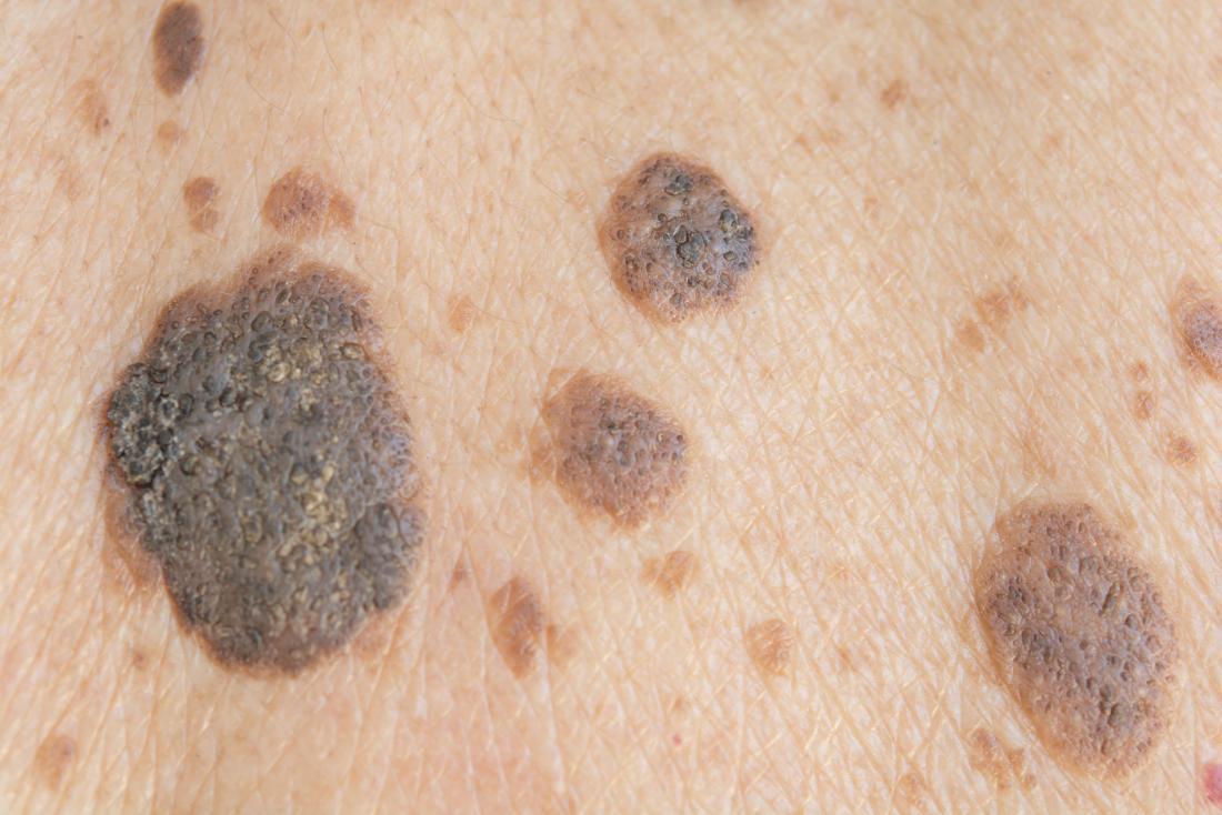 Seborrheic Keratosis Dermatology Conditions And Treatments