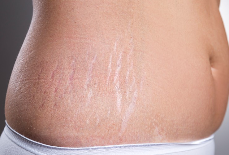 Stretch Marks Dermatology Conditions And Treatments 