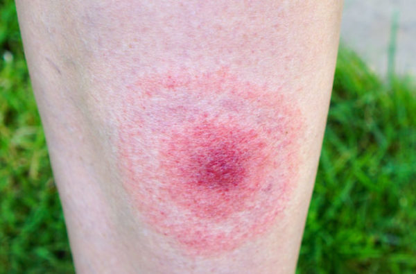 Lyme Disease Dermatology Conditions And Treatments